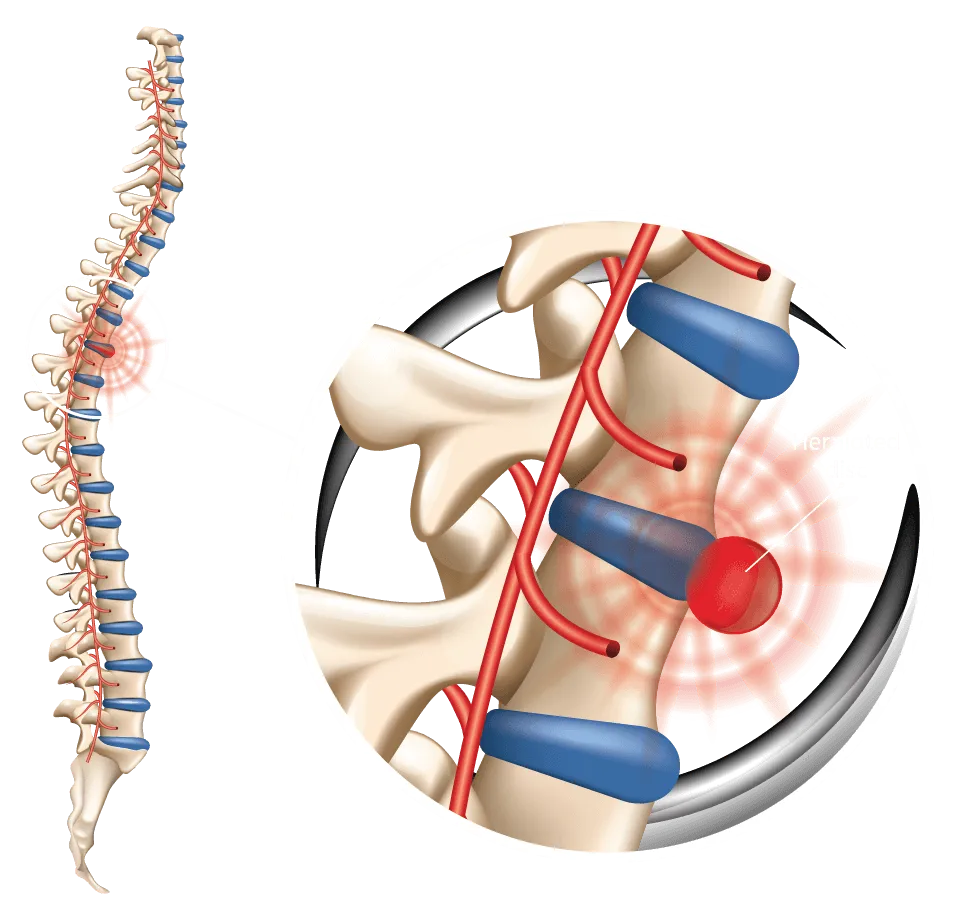 Spinal Decompression Warrenton MO Spine Chart Spinal Decompression Warrenton MO Spine Chart